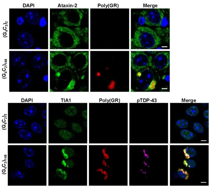 Confocal immunofluorescence of C9orf72 repeat model cells showing DAPI-stained nuclei with poly(GR), ataxin-2, TIA-1, and phosphorylated TDP-43 forming colocalised cytoplasmic inclusions.