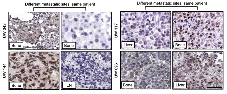 Immunohistochemistry of metastatic castration-resistant prostate cancer biopsies from bone, lymph node, and liver, showing brown nuclear staining for the androgen receptor splice variant AR-V7.